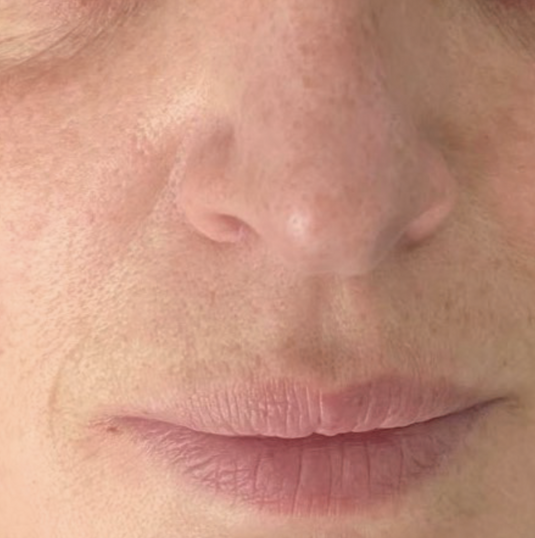 After XPL treatment showing the nose and lip area with improved skin tone, reduced redness, smoother texture, and a more even complexion.