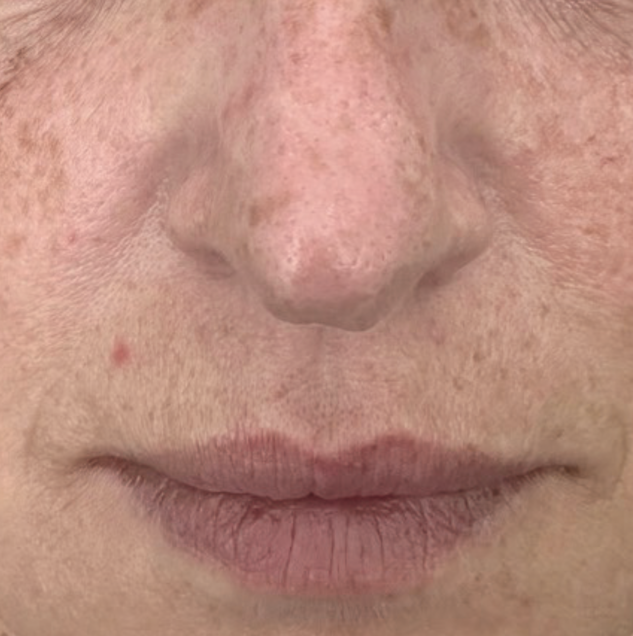 Before XPL treatment showing the nose and lip area with visible redness, uneven skin tone, sun damage, and enlarged pores.