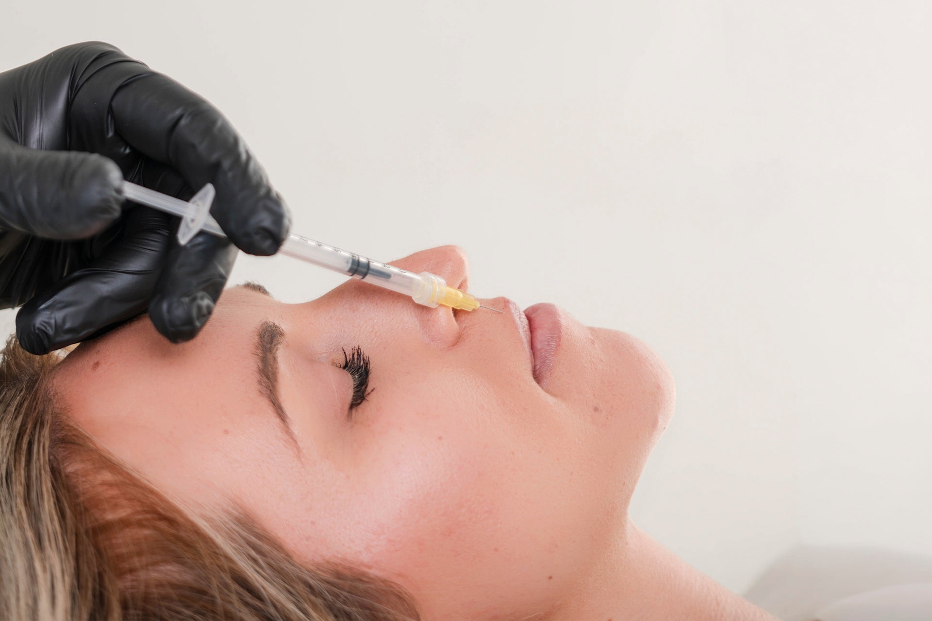 Dermal filler treatment for nasolabial folds performed by a licensed aesthetic provider in St. Augustine