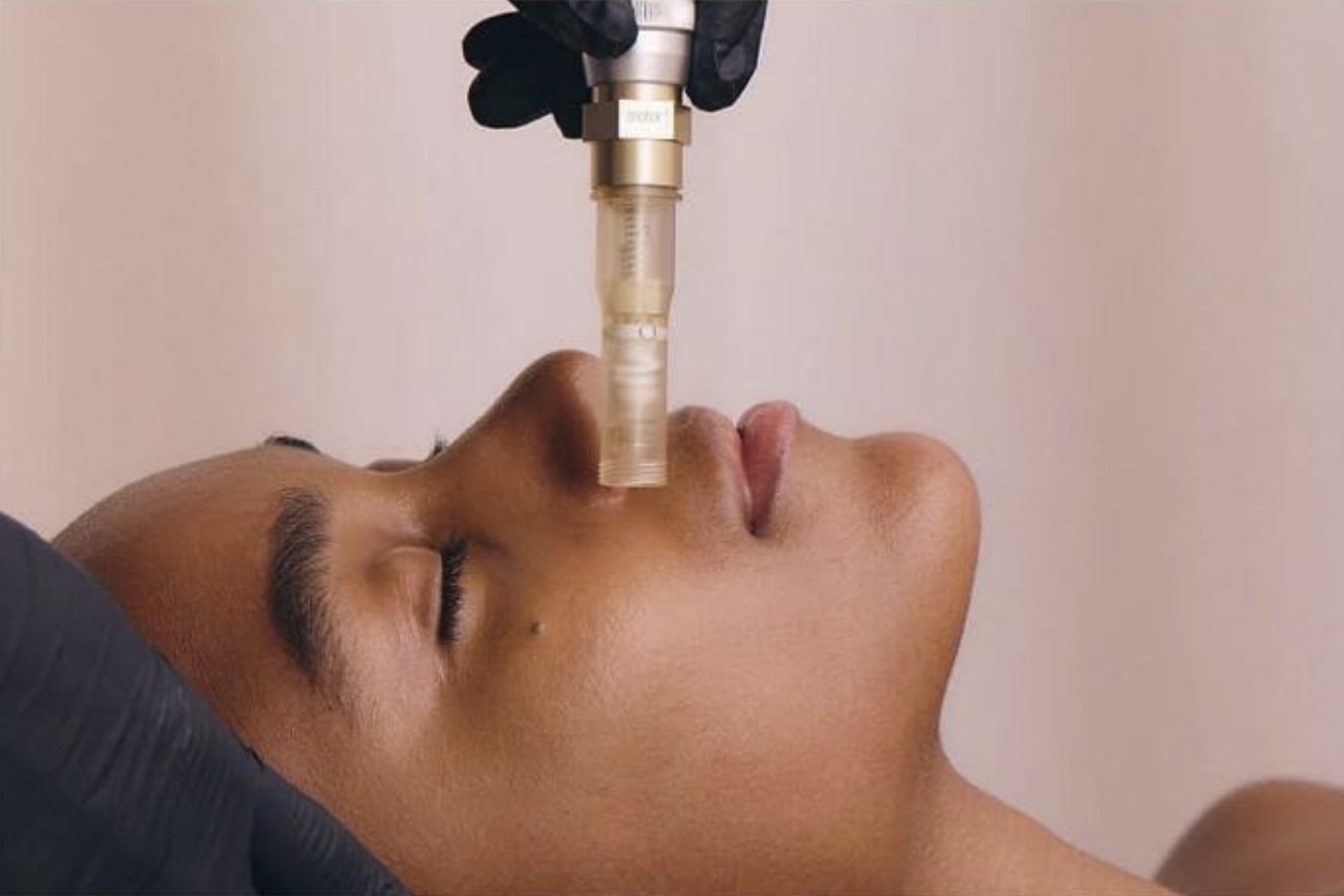 SkinStylus microneedling treatment stimulating collagen and skin rejuvenation performed in St. Augustine Florida